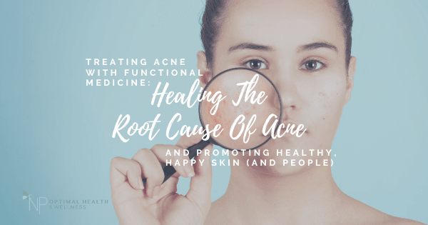 Treating Acne With Functional Medicine: Healing The Root Cause Of Acne And Promoting Healthy, Happy Skin (And People) Treating Acne With Functional Medicine: Healing The Root Cause Of Acne And Promoting Healthy, Happy Skin (And People)
